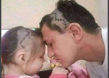 بیٹی کی دماغ کی سرجری،باپ نے بیٹی جیسا ہئیراسٹائل بنوالیا