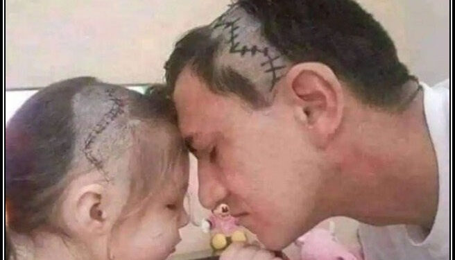 بیٹی کی دماغ کی سرجری،باپ نے بیٹی جیسا ہئیراسٹائل بنوالیا