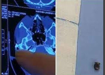 20 سال بعد ایک شخص کے سرسے گولی نکال دی گئی