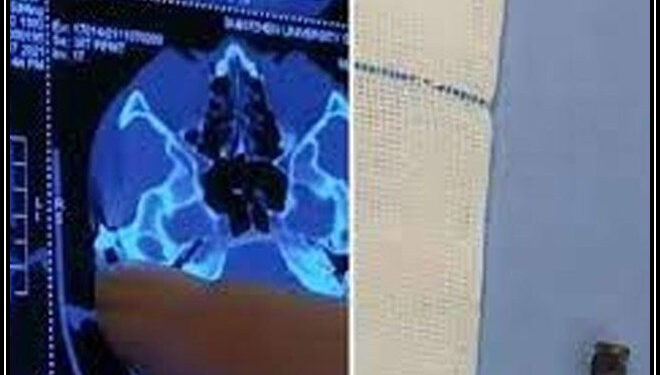 20 سال بعد ایک شخص کے سرسے گولی نکال دی گئی