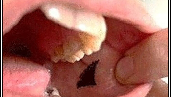 گال کے اندر چپکائے جانے والے انسولین اسٹیکر