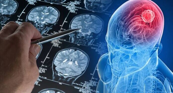 پاکستان سمیت دنیا بھر میں برین ٹیومر کا عالمی دن منایا گیا