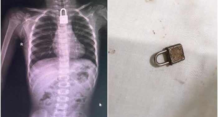 فیصل آباد: نجی اسپتال میں کامیاب آپریشن، 3 سالہ بچےکےگلے میں پھنسا تالا نکال لیا گیا۔